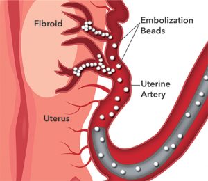 Uterine fibroid embolization | Sound Vascular